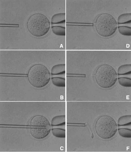 FIGURE 4 Oocyte enucleation. (A) Rotate and find the metaphase II spindle and place it in the 8 to 10 o'clock position. Then hold this oocyte on the holding pipette. (B) Cut the zona pellucida using an enucleation pipette with piezo pulses. (C) Insert enucleation pipette until it reaches the spindle. (D) Remove the spindle by suction without breaking the plasma membrane and gently pull away the pipette from oocytes. (E) The stretched cytoplasmic bridge from oocytes to pipette was pinched off. (F) Push out the spindle in order to check enucleation, which is harder than cytoplasm.