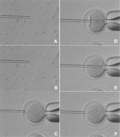 FIGURE 5 Donor nucleus injection. (A and B) Donor nuclei are aspirated in and out of the injection pipette gently until their nuclei are largely devoid of visible cytoplasmic material. (C) Hold the enucleated oocyte and cut the zona pellucida using piezo pulses. (D) Insert the injection pipette into enucleated oocyte. (E) Apply a single piezo pulse to break the membrane and immediately inject the donor nucleus. (F) Pull the pipette away gently.