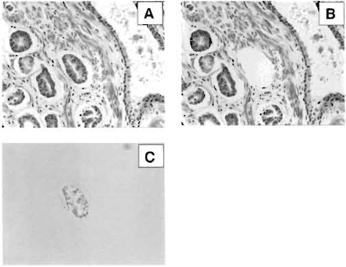FIGURE 2 Laser capture microdissection of an individual gland in breast ductal carcinoma. (A) H&E stain of heterogeneous human breast tissue, (B) microdissection of the gland of interest, and (C) polymer-cell composite after transfer to film.