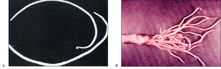 A, Intestinal roundworm Ascaris lumbricoides, male and female. Male, top, is smaller and has characteristic sharp kink in the end of the tail. Females of this large nematode may be over 30 cm long. B, Intestine of a pig, nearly completely blocked by Ascaris suum. Such heavy infections are also fairly common with A. lumbricoides in humans.