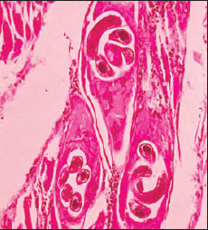 Section of muscle infected with trichina worm Trichinella spiralis, human case. The juveniles lie within muscle cells that the worms have induced to transform into nurse cells (commonly called cysts). An inflammatory reaction is evident around the nurse cells. Juveniles may live 10 to 20 years, and nurse cells eventually may calcify.