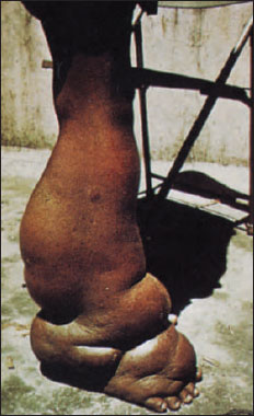 Elephantiasis of leg caused by adult filarial worms of Wuchereria bancrofti, which live in lymph passages and block the flow of lymph, Tiny juveniles, called microfilariae, are ingested with blood meal of mosquitos, where they develop to infective stage and are transmitted to a new host.