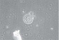 KOH preparation of lung biopsy material showing spherule (yeast form) of Coccidioides immitis. Many endospores bud off from the thick-walled spherule, which has burst, releasing the endospores into the surrounding tissue. Each endospore is able to form a new spherule. In culture, this dimorphic fungus will grow as the filamentous hyphal form.