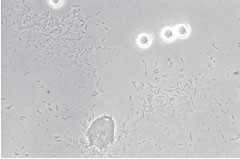Acanthamoeba trophozoite (bottom center) and cysts (refractile objects at top right) isolated from the contact lens