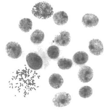 FIGURE 1 Karyotypic analysis of emerging hybrids. The in situ karyotyping method (Worton and Duff, 1979) was performed on rat hepatoma-derived hybrid colonies 8 days after fusion. The colony shown was composed of 17 cells, 1 of which was in metaphase. This metaphase contains 100 chromosomes, corresponding to the expected sum of the mean chromosome number of each parent (46 and 52, respectively).