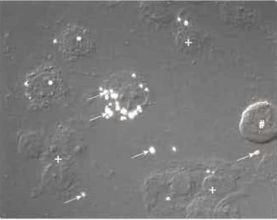 FIGURE 2 Nomarski interference microscopy image of M. smegmatis-infected J774 macrophages treated with a syringe equipped with a 22-gauge needle 10 times. *, cells in the process of breaking; +, nuclei with associated cell debris; #, intact cell; arrows indicate M. smegmatis-containing phagosomes that are phase refractile.