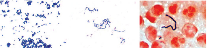 Streptococcus pyogenes in Gram-stained smears. From a culture plate (left), the gram-positive organisms appear singly, in chains, and in clumps. In broth culture media (center), the characteristic long chains are seen. In a smear from an abscess (right), the organisms are primarily gram-positive cocci in long chains.